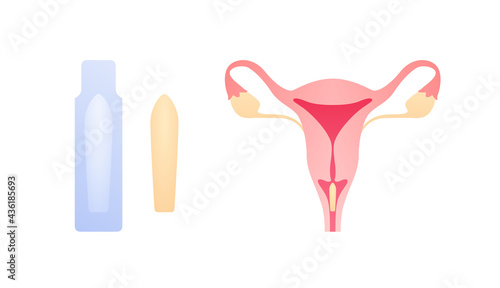 Female reproductive system illness treatment concept. Vector flat medical illustration. Suppository medicine apply in vagina and package isolated on white background. Design for healthcare, gynecology
