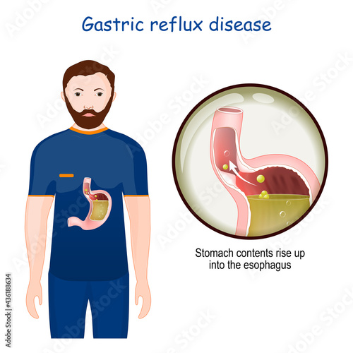 Gastroesophageal reflux disease. Close-up of stomach with GERD.