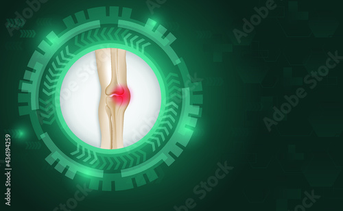 Illustration of Arthritis  joint . Rheumatoid arthritis. Pain in leg. Human bone anatomy flat vector illustration. Painful injury erosion on a green technology background.