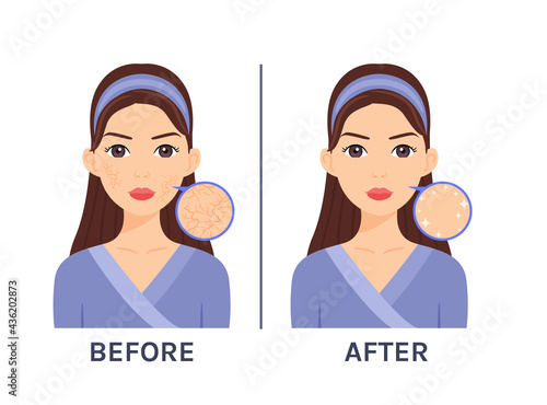 Cute Girl and Dry Skin on her Face. Before and after.Cracked skin and soft, smooth skin. Flat cartoon color fashion style. White background.Vector illustration.