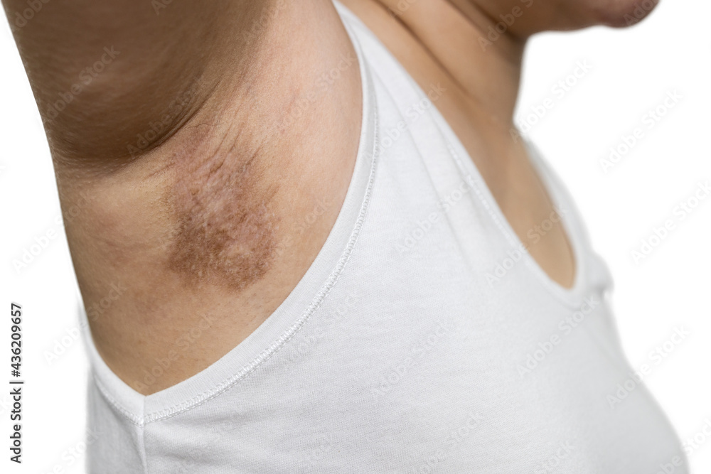 Asian young woman showing a scar on the skin of the armpits after laser hair removal under the