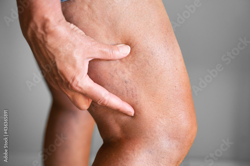 Leg Vein Varicose Disease And Pain