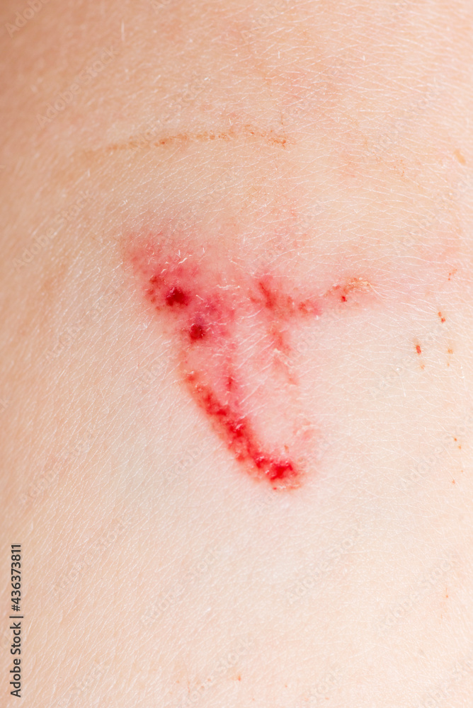 A wound on the human body, deep cut, scar closeup. Deep scratches on the skin with bruises