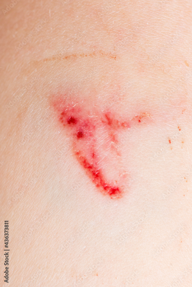 A wound on the human body, deep cut, scar closeup. Deep scratches on the skin with bruises A wound on the human body, deep cut, scar closeup. Deep scratches on the skin with bruises