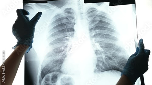 A woman in medical gloves shows fluorography. X-ray of the lungs with the initial stage of pneumonia