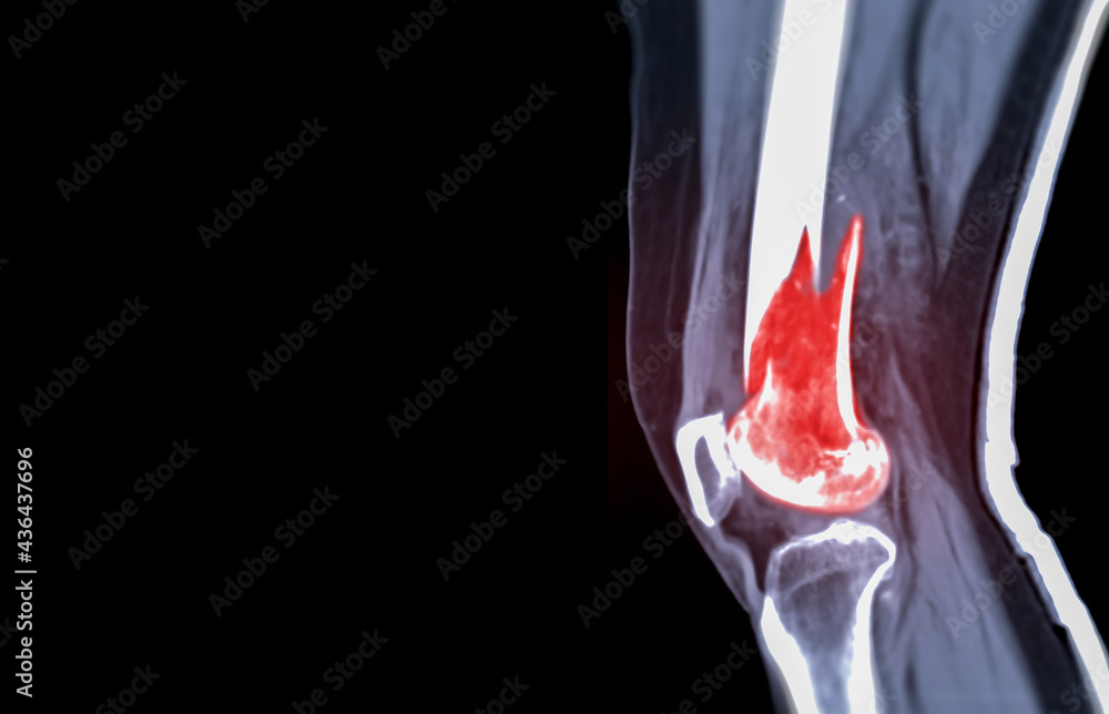 CT knee 3D rendering image Lateral view isolated on black background ...