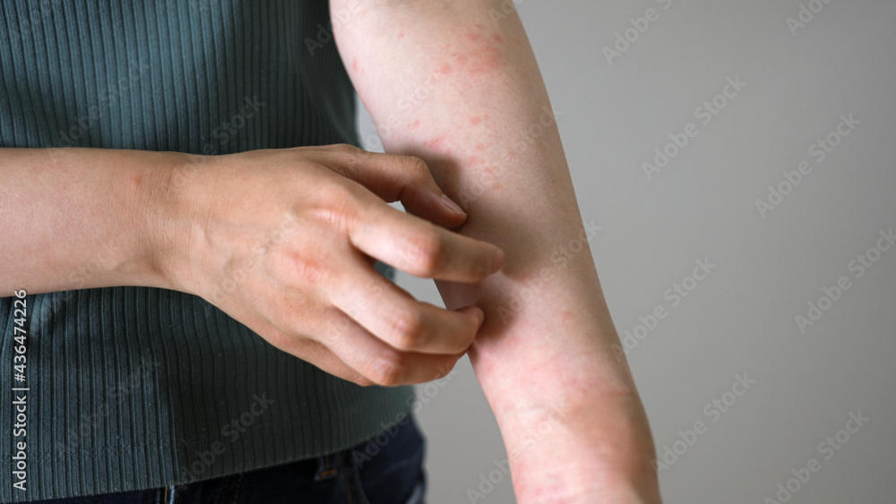 ストレスで腕に湿疹が出る女性stock Photo Adobe Stock