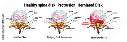 Healthy spine disk. Protrusion. Herniated Disk. Bulging Disk. The anatomical structure of the spine. Compressed nerve endings. Medical vector illustration.