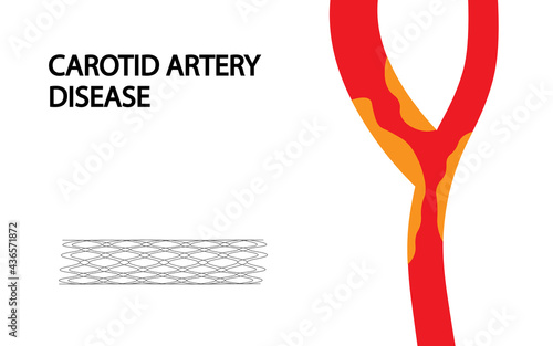 Carotid Artery Disease illustration. Carotid artery blockage. photo