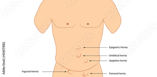Types of hernia. Anatomy hernia illustration 