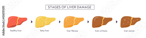 Stages of nonalcoholic liver damage. Healthy, fatty, steatosis, NASH, fibrosis, cirrhosis, cancer. Medical infographic of Liver Disease. Vector banner in flat cartoon style on white background.