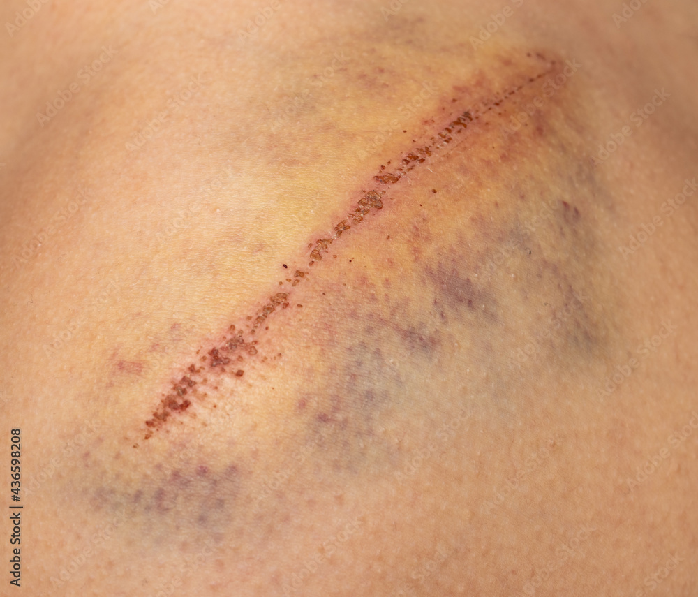 Fototapeta premium deep scratch with a bruise on the skin of the shoulder