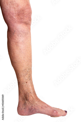 Leg of an elderly Caucasian woman with spider veins and varicose veins on toes isolated on white background. Concept of health care, cosmetic surgery, beauty issue. Inner side of leg, side view. © fotorauschen