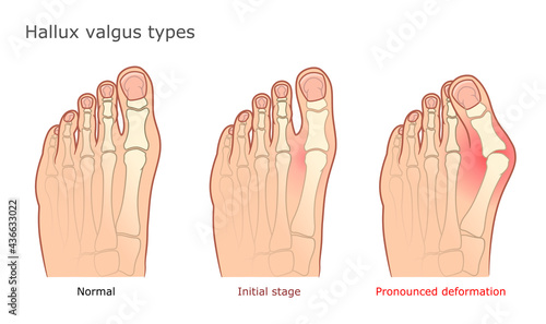 Medical vector illustration of Hallux valgus types. Healthy foot, initial stage and pronounced deformation.  photo