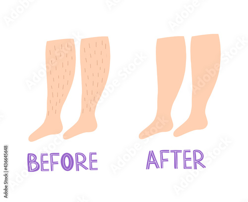 Women's unshaven legs. Feminism, women's freedom of choice. Design of posters of feminism. Body positive. Love your body. The procedure of depilation of the legs. Advertising for hair removal.