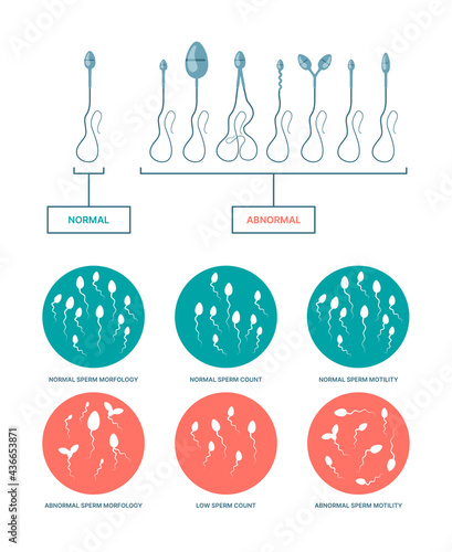 Spermogram. Medical infographic with healthy and damaged spermatozoa birth plan ovulation processes garish vector flat templates