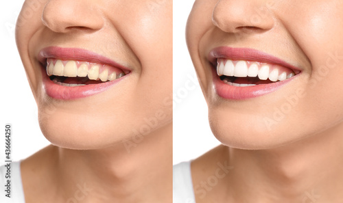 Collage with photos of woman before and after teeth whitening  closeup