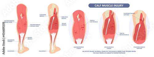 Calf Pain leg back muscle blood vessels nerve acute sport damage arterial trauma tennis soccer tear Cramp spasm Charley horses medial fiber bruising run walk tendon Clot deep vein pull torn up sprain