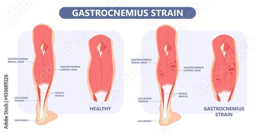 Calf Pain leg back muscle blood vessels nerve acute sport damage arterial trauma tennis soccer tear Cramp spasm Charley horses medial fiber bruising run walk tendon Clot deep vein pull torn up sprain