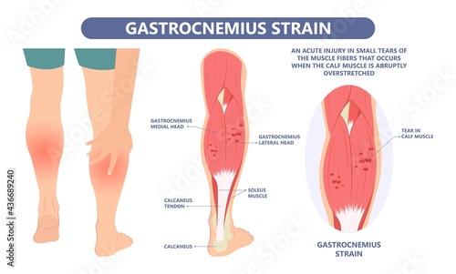Calf Pain leg back muscle blood vessels nerve acute sport damage arterial trauma tennis soccer tear Cramp spasm Charley horses medial fiber bruising run walk tendon Clot deep vein pull torn up sprain