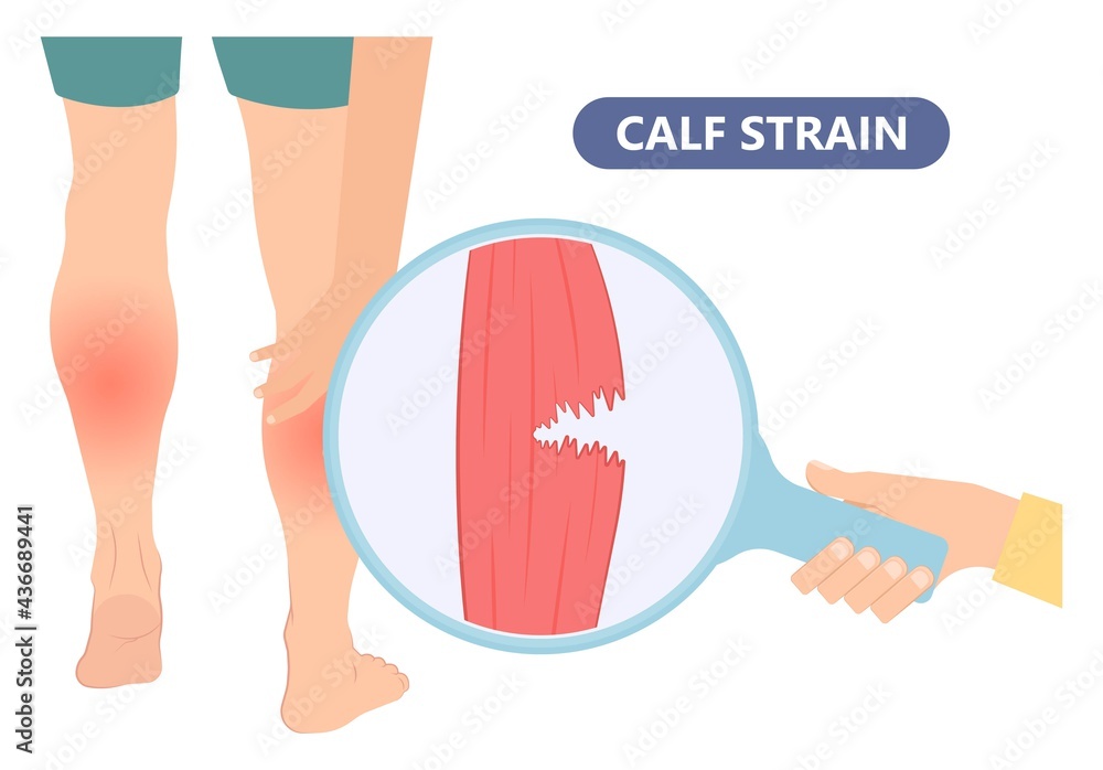 Calf Pain leg back muscle blood vessels nerve acute sport damage