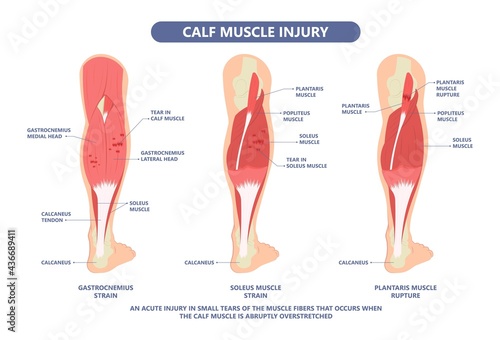 Calf Pain leg back muscle blood vessels nerve acute sport damage arterial trauma tennis soccer tear Cramp spasm Charley horses medial fiber bruising run walk tendon Clot deep vein pull torn up sprain