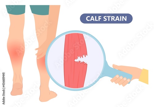 Calf Pain leg back muscle blood vessels nerve acute sport damage arterial trauma tennis soccer tear Cramp spasm Charley horses medial fiber bruising run walk tendon Clot deep vein pull torn up sprain