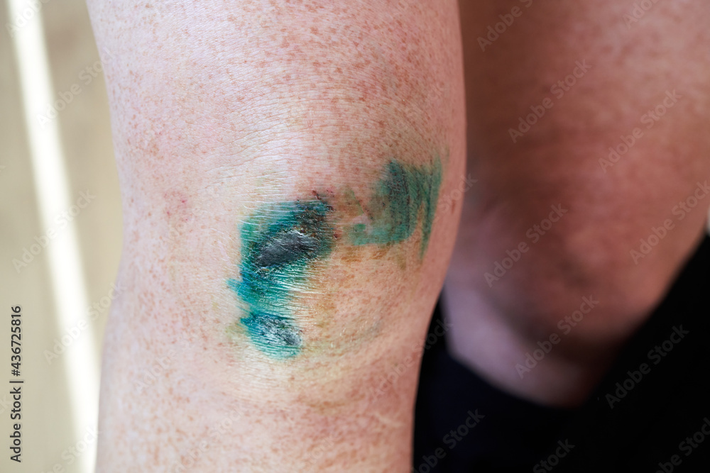 Fototapeta premium Woman with dog bite marks on her body