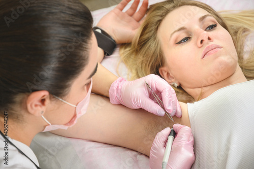 Doctor remove hair permanently in a blonde woman's armpits using metod electro epilation in cosmetology beauty salon. Close up.