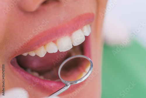 Closeup of a female patient with an open mouth during oral checkup at the dentist.