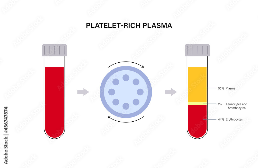 Platelet rich plasma concept Stock Vector | Adobe Stock