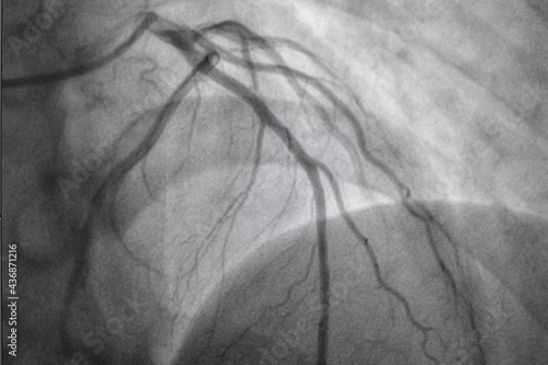 Coronary angiography, Coronary artery disease. Medical x-ray of heart disease. Healthcare and medical concept. photo