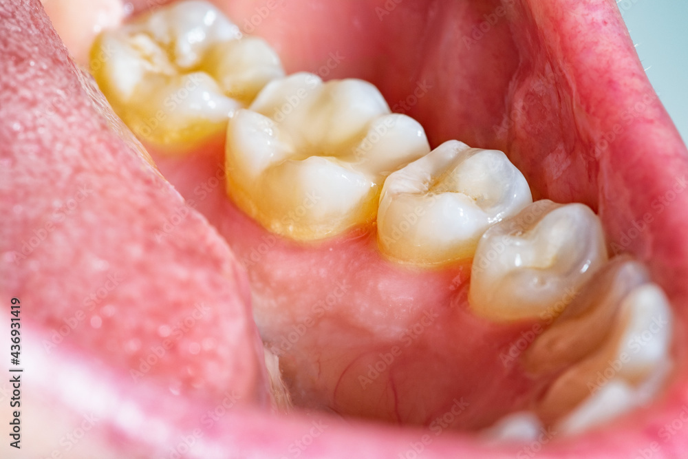 Lower dental arch full of plaque. Layer of bacterial plaque around the