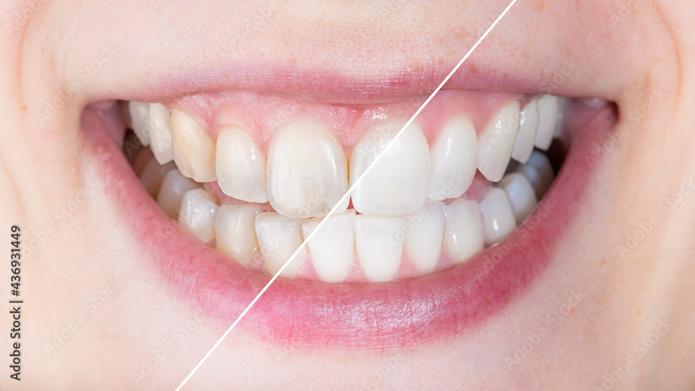Before and after whitening treatment or application of dental veneers
