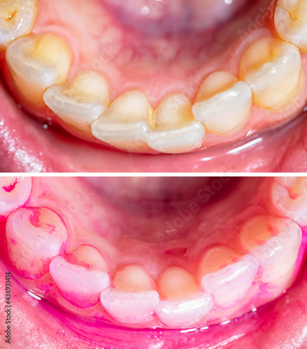 Concept of deep and detailed cleaning of the teeth. Pink disclosing tablets or gel for reveal and remove plaque and tartar. Vertical before and after dental cleaning. Removal of yellow plaque.