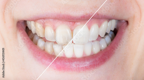 Konstfotografi Before and after whitening treatment or application of dental veneers