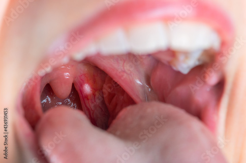 Close up on a canker sores. Inflammation of oral cavity. Very painful aphthae on uvula or soft palate. Really disturbing mouth ulcers. Anatomy of a inflamed buccal cavity. Reddened buccal mucosa. photo