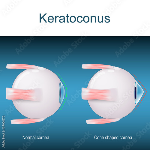 Keratoconus. eyes disorder