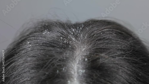 The concept of diseases of the scalp. Dirty dark hair with dandruff close-up. Top view. Movement along the parting of the hair. photo