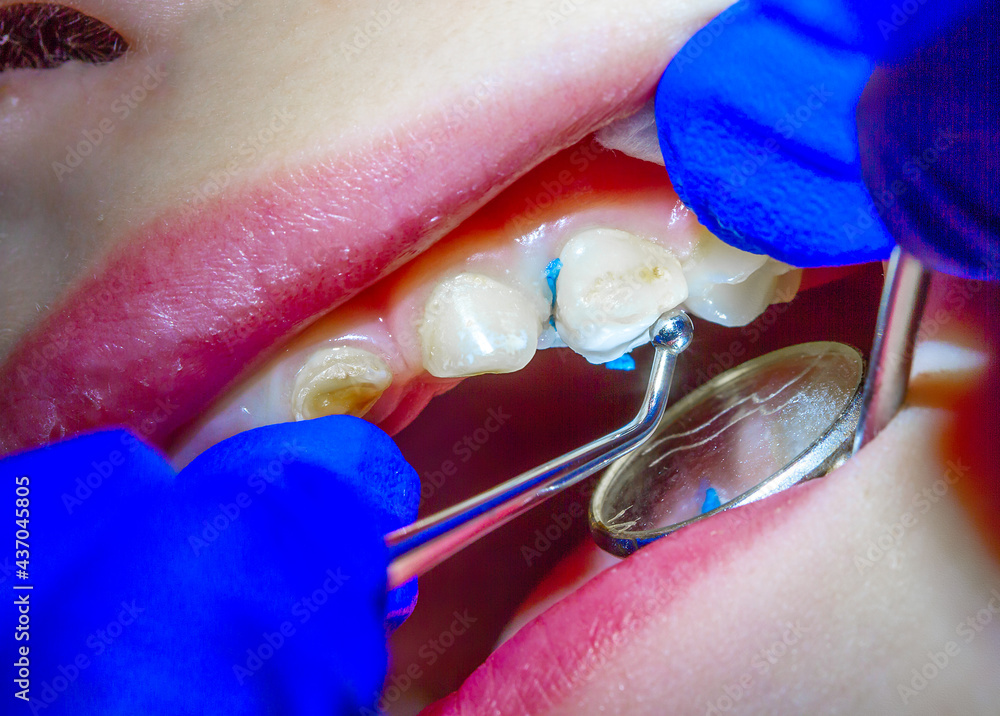 Treatment of baby teeth in a child, dental drill, installation and