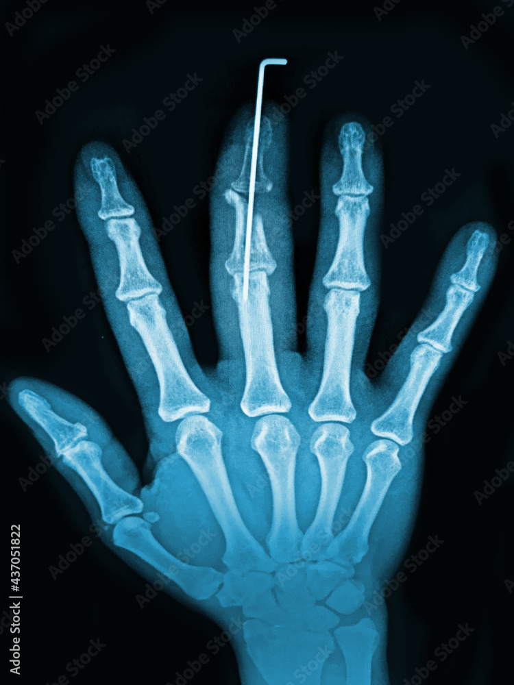 x ray of hand x ray of hand