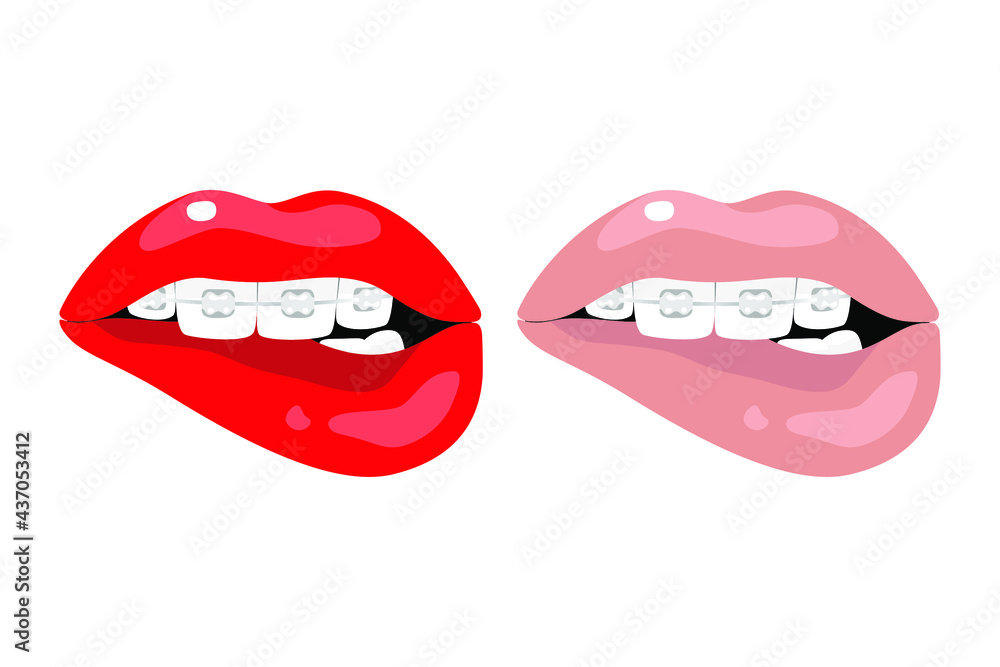 Dental braces, bright red and natural beige sexy female lips. Teeth, dentistry, orthodontics, medicine, health, beauty, aesthetics. Set of vector isolated illustrations on white background