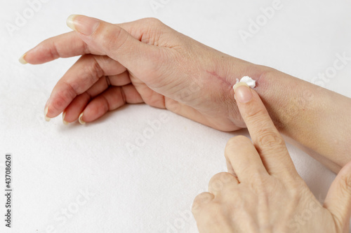 Fotografie Applying a special medical cream or salve  to a healing scar after tendon surgery on a woman's hand