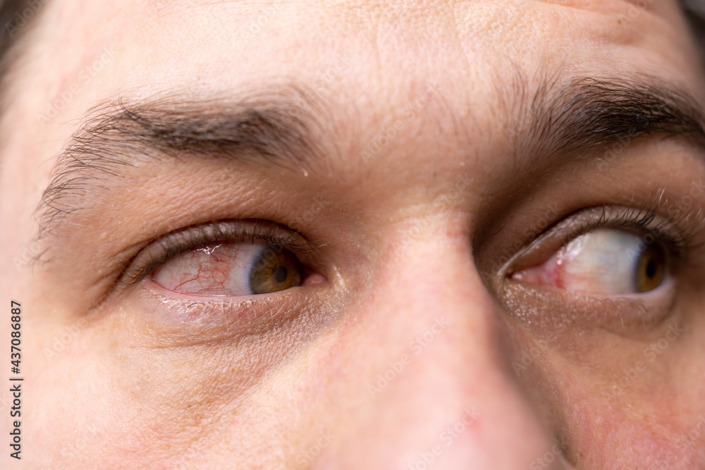 sore eye closeup. Burst blood vessels in the eyeball. Allergic