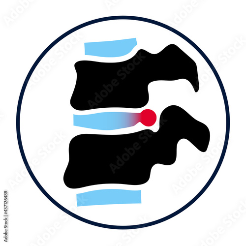 intervertebral hernia concept