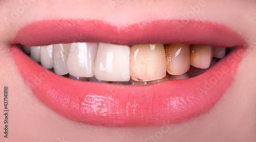 Perfect smile whitening before and after veneers bleach of zircon whitening young lady smiling . Implants crowns. Dental restoration treatment clinic patient . Oral Care concept surgery procedure 