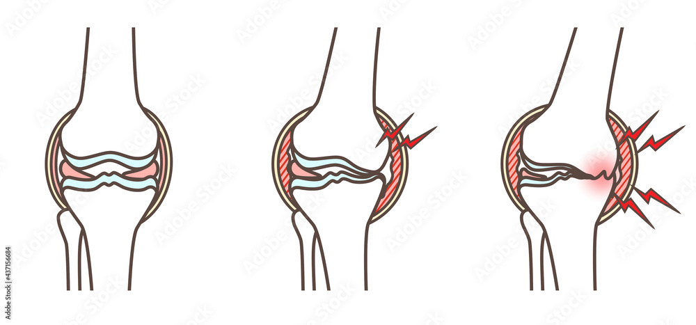 変形性膝関節症のイラスト Stock Illustration Adobe Stock