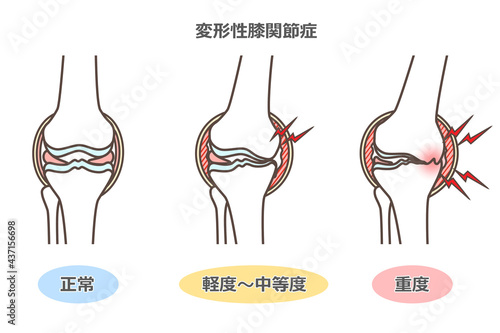 変形性膝関節症のイラスト