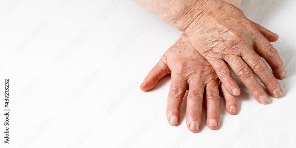 Fototapeta premium Aging hands of an old 80 year old woman with age spots, deep wrinkles on the skin and flaky nails. Skin aging and elderly care concept. Female hands on white fabric