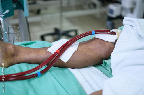 patient's leg with extracorporeal membrane oxygenation line (ECMO) on bed at critical care unit (CCU)